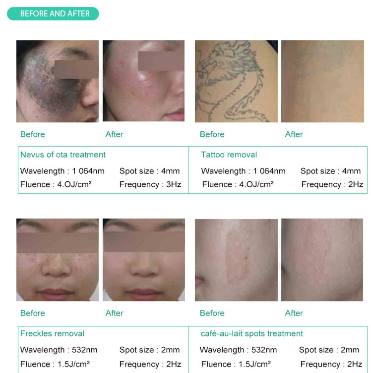 Q Switch ND YAG Tattoo Removal Machine