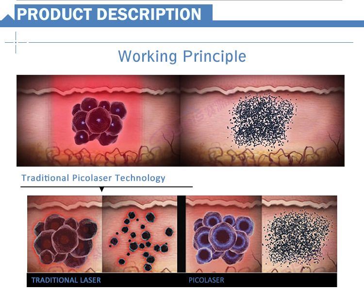 FDA Approved Tatto Removal Machine