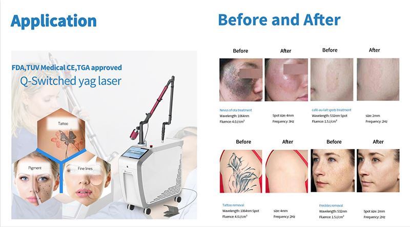 Q-laser remove acne Q-laser remove acne