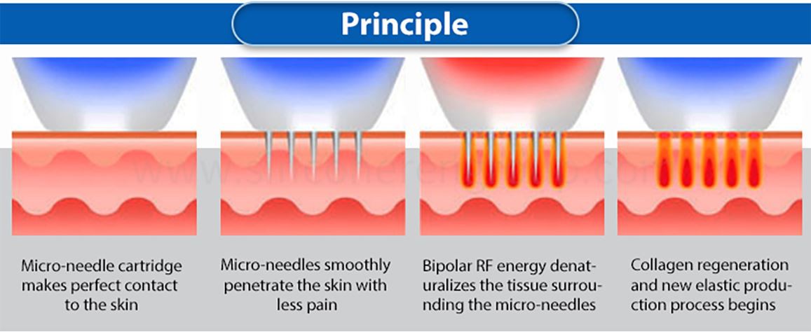 3-in-1-microneeding-(2) 3-in-1-microneeding-(2)