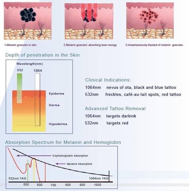 ND YAG remove tattoos whitening ND YAG remove tattoos whitening