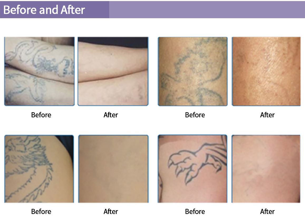 Portable-IPL-(7) Portable-IPL-(7)