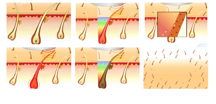 Medical CE/ISO13485 approved Intense pulsed light Sienna IPL  with shr two handles for hair removal and skin rejuvenation
