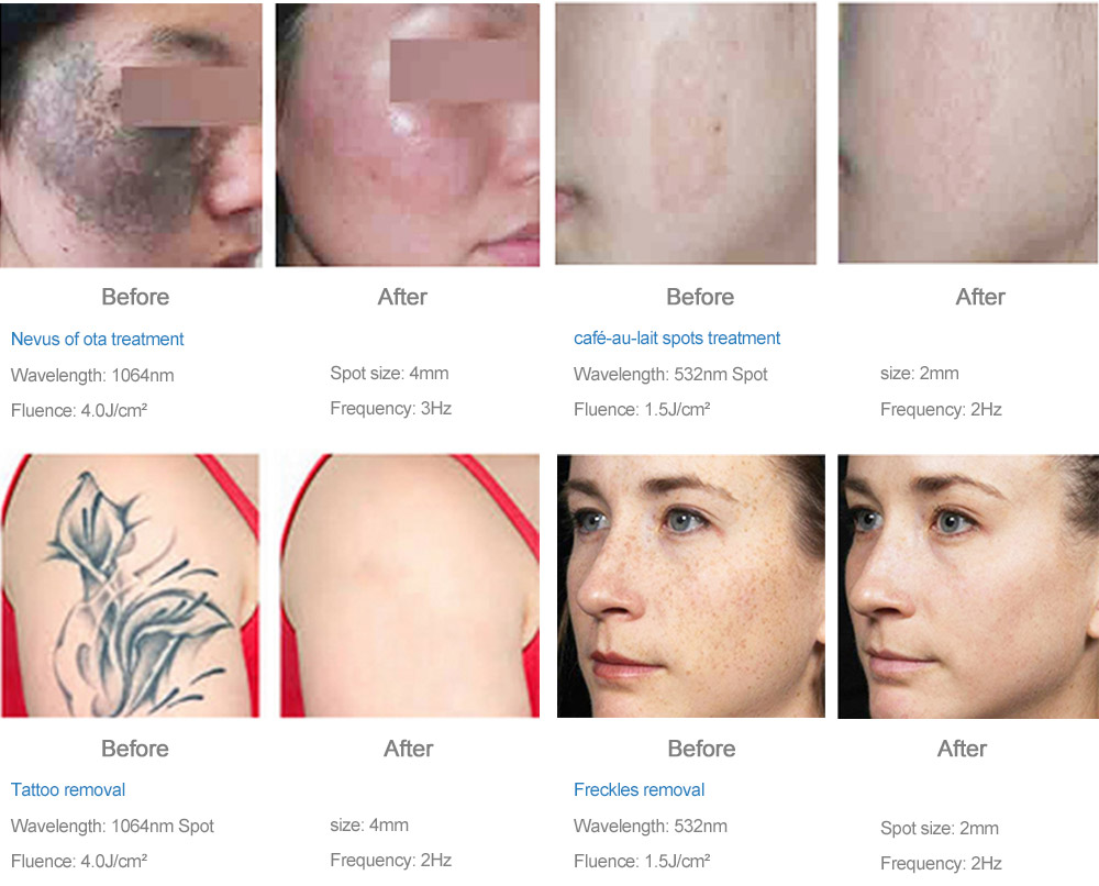 Q-Switched Nd:YAG 激光治疗系统 ExQ-Laser Q-Switched Nd:YAG 激光治疗系统 ExQ-Laser