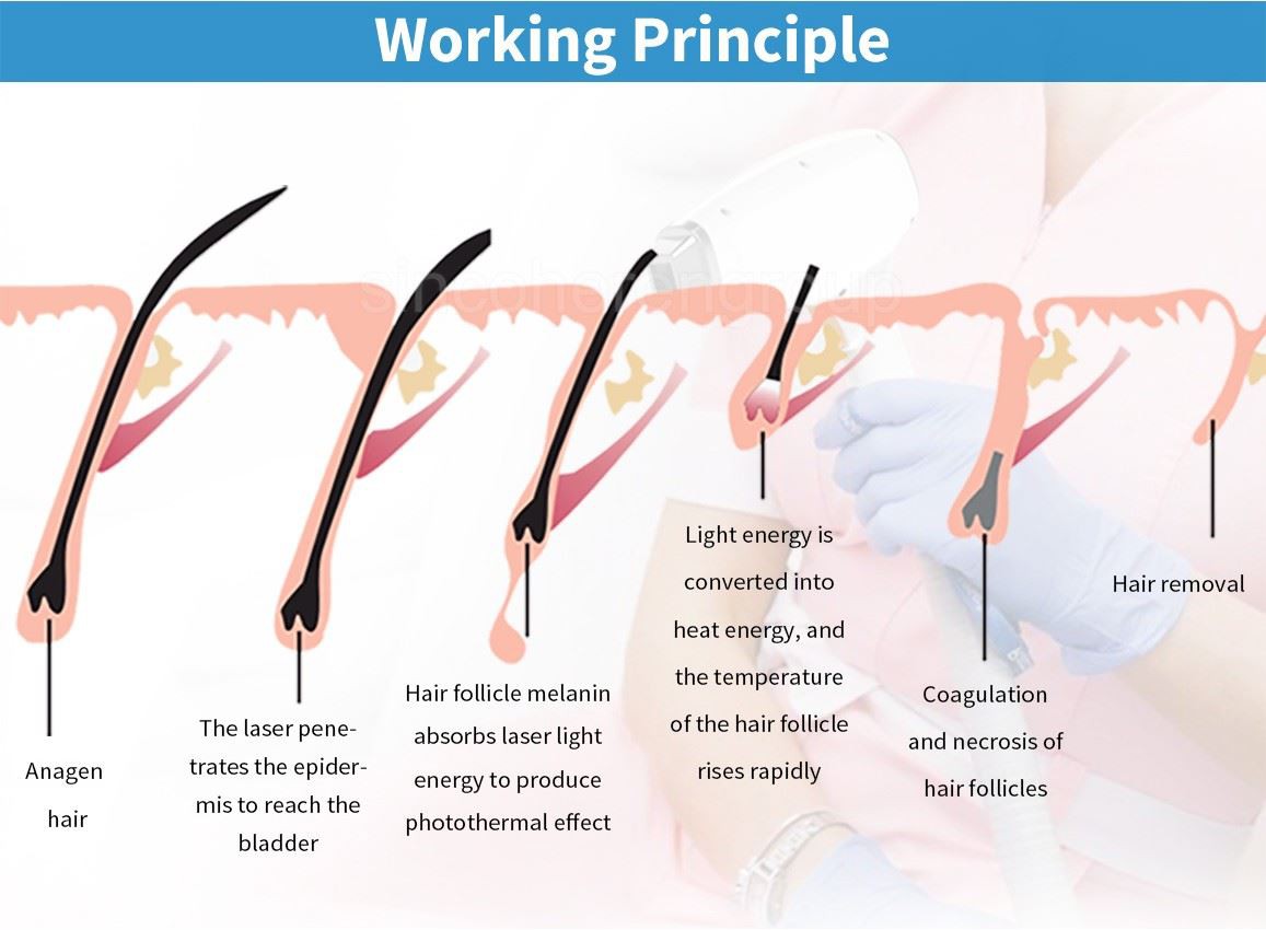 diode ice laser kopen