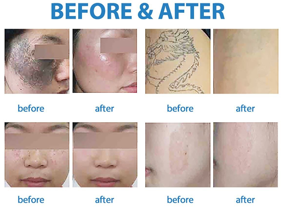 picosecond laser machine