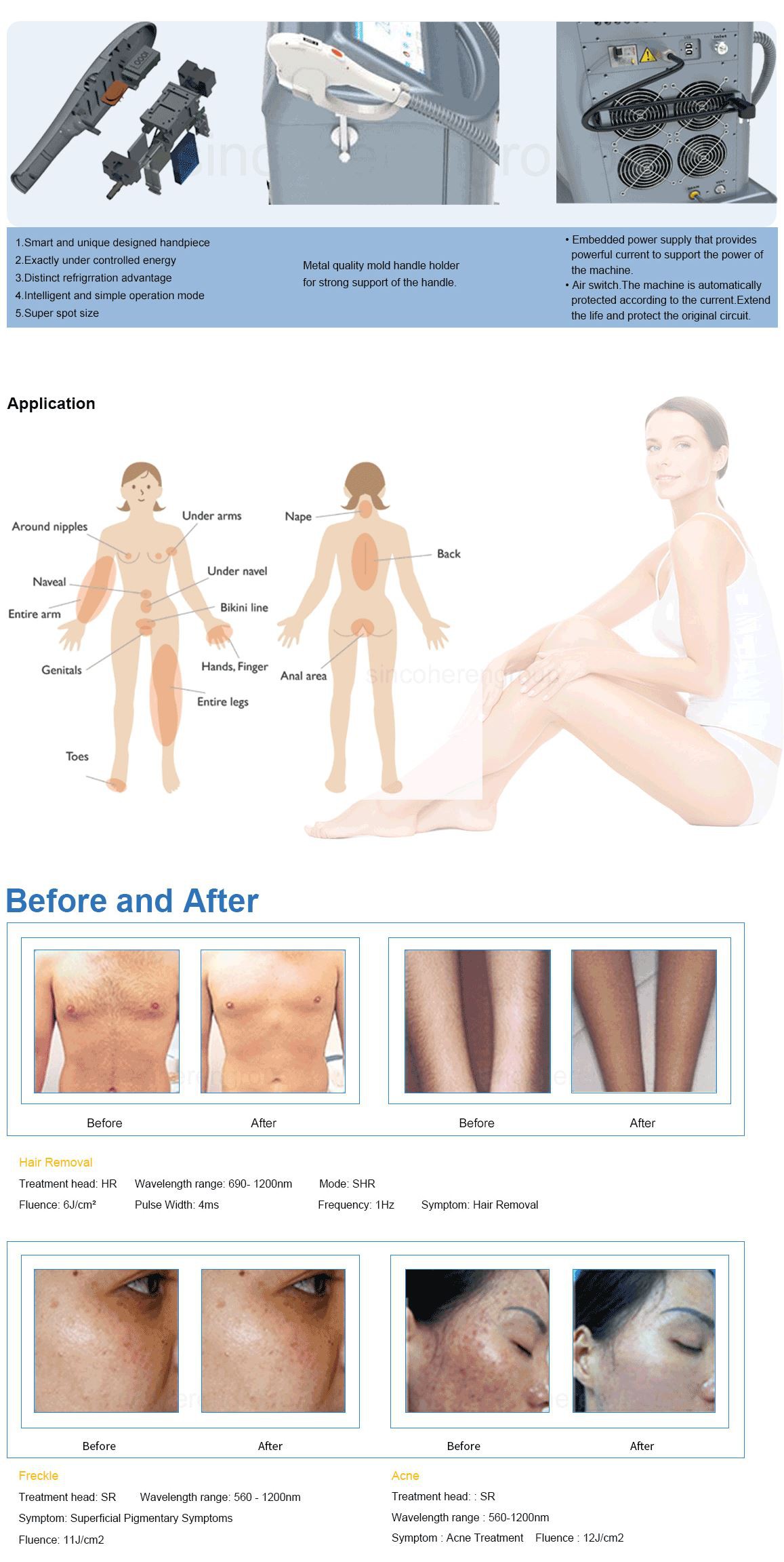 IPL hair removal.4 IPL hair removal.4
