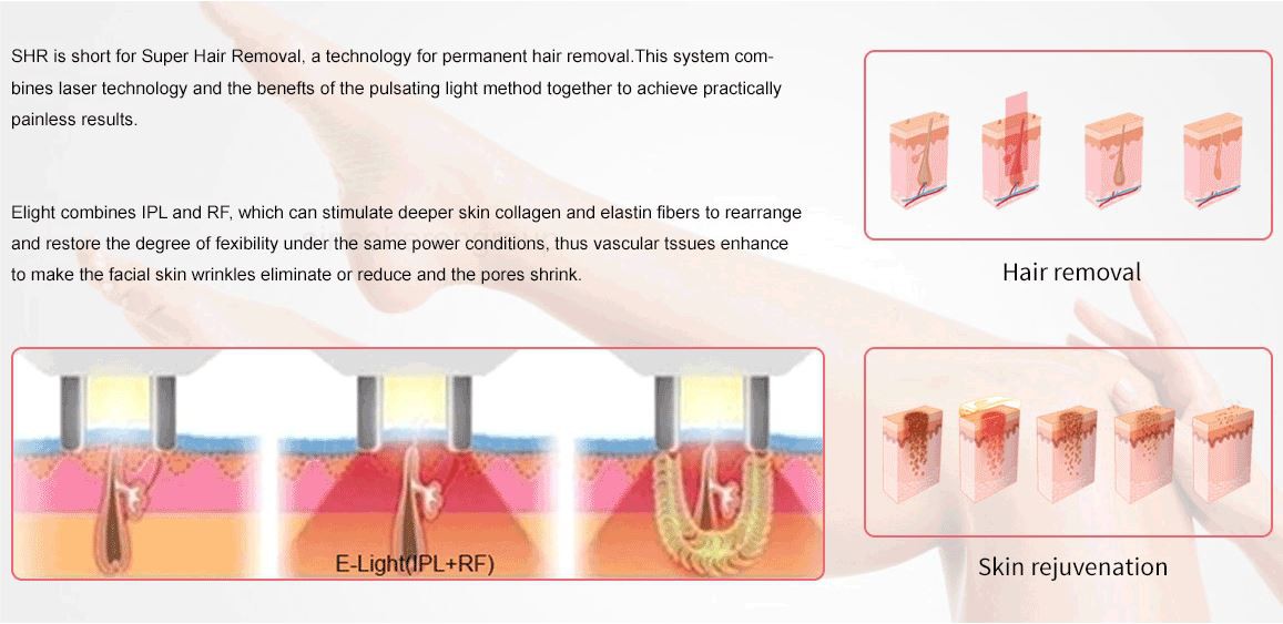 IPL hair removal.2