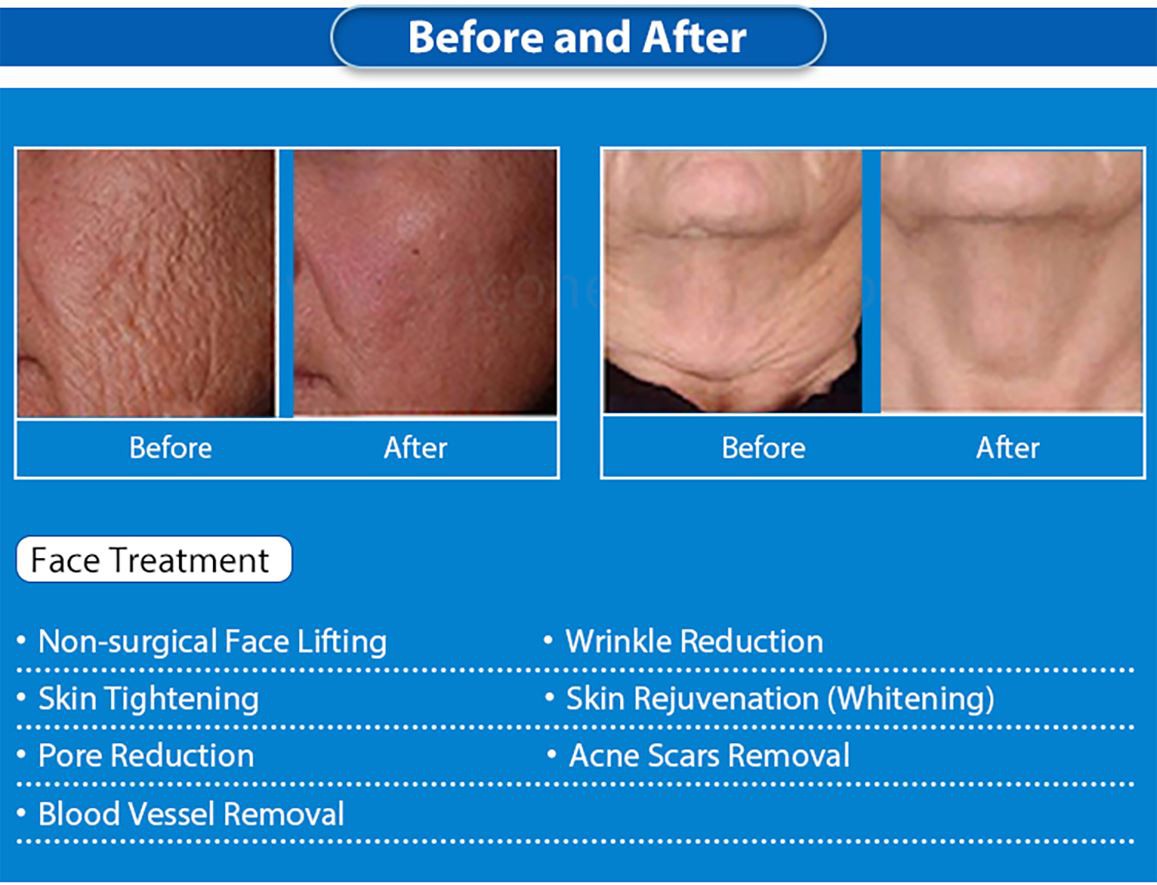 3-in-1-microneeding-(6)