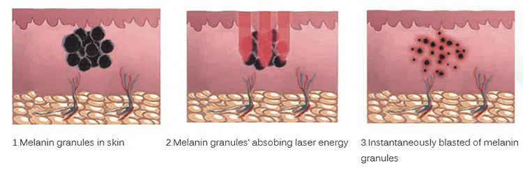 nd yag laser tattoo removal machine