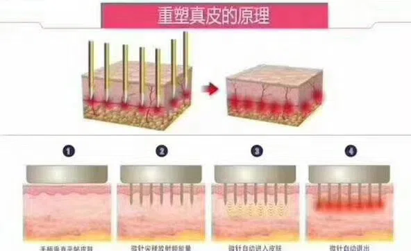 microneedle microneedle