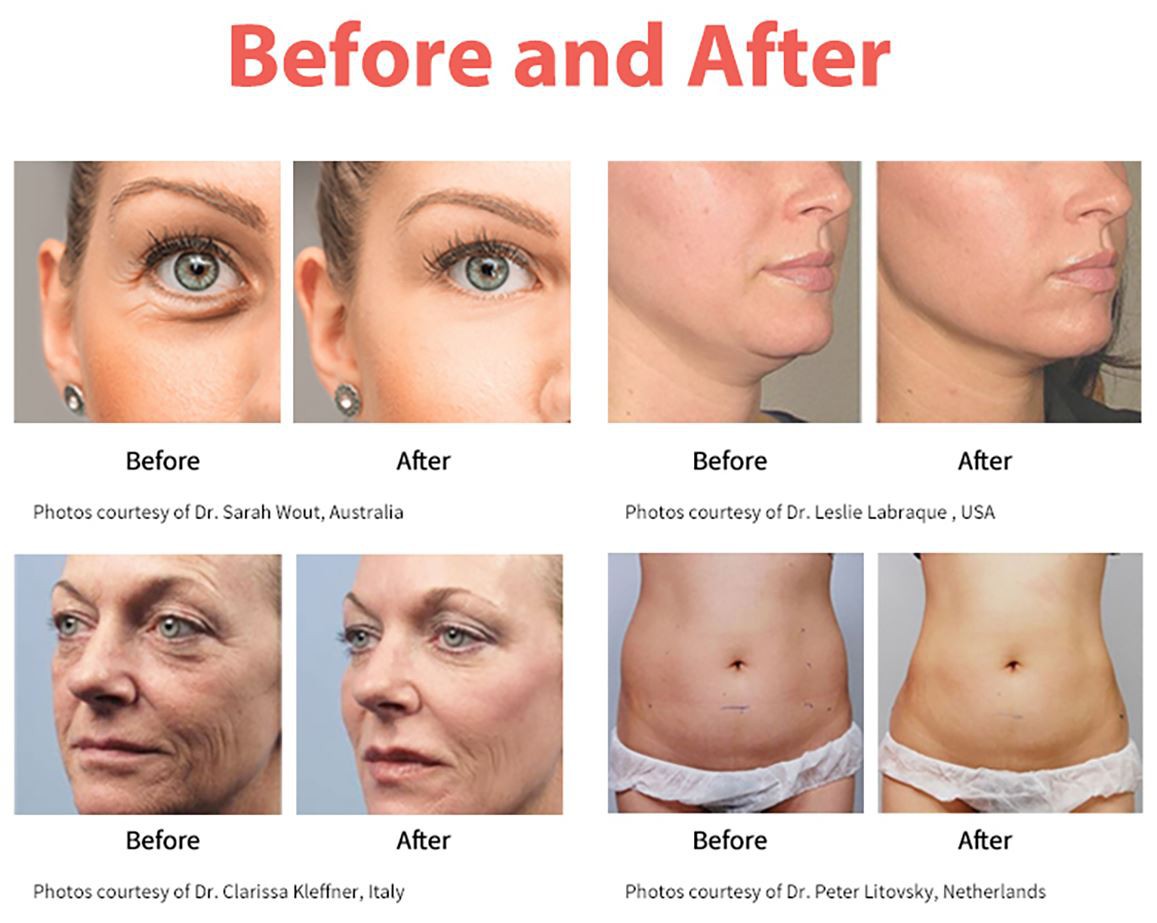 5D-HIFU-(9) 5D-HIFU-(9)