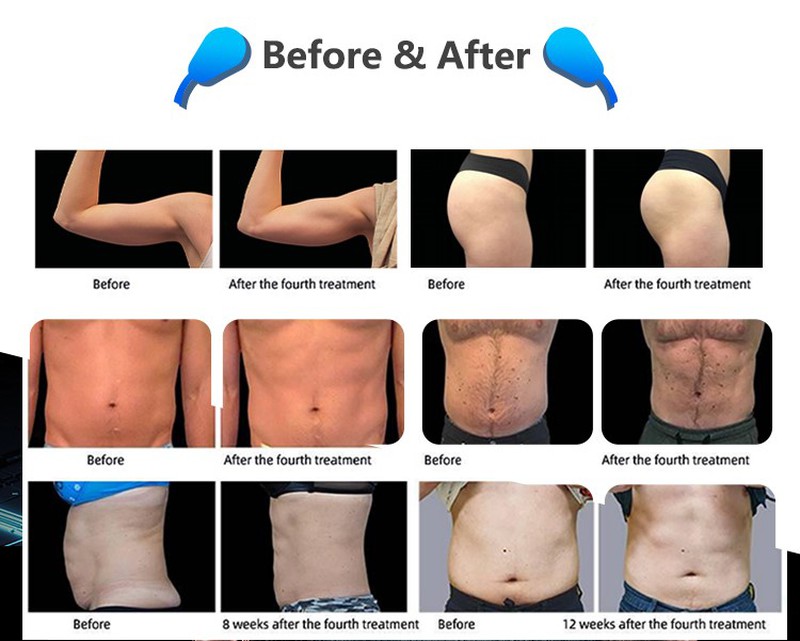 emssculpting machine emssculpting machine