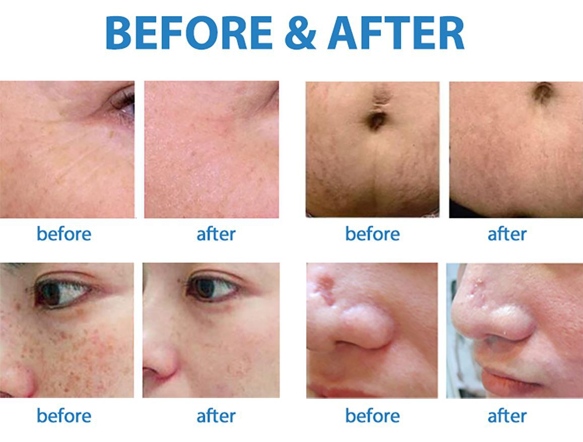 CO2-laser-(8) CO2-laser-(8)