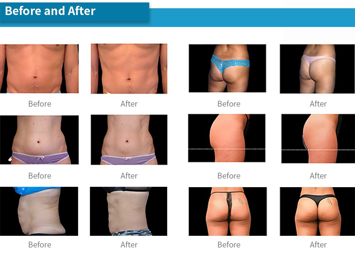 CelluSculpt-7 CelluSculpt-7