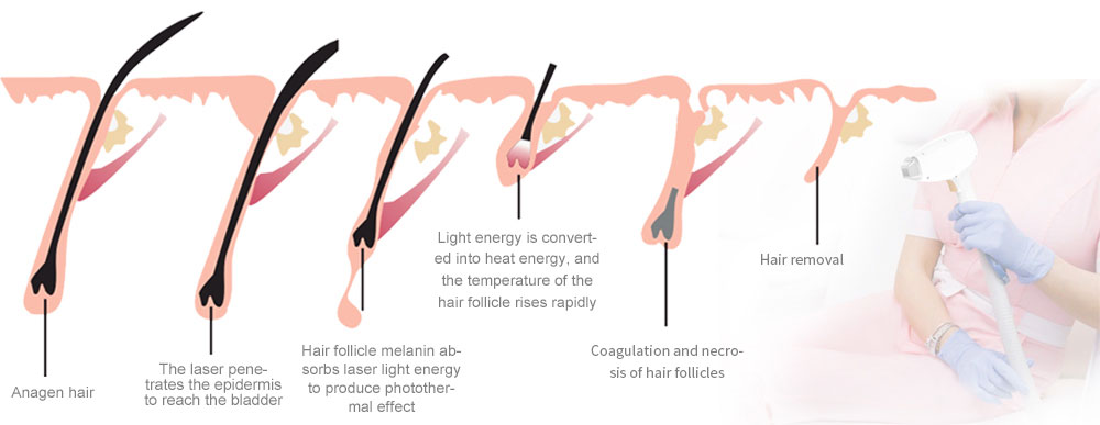 Upgraded diode laser hair removal machine