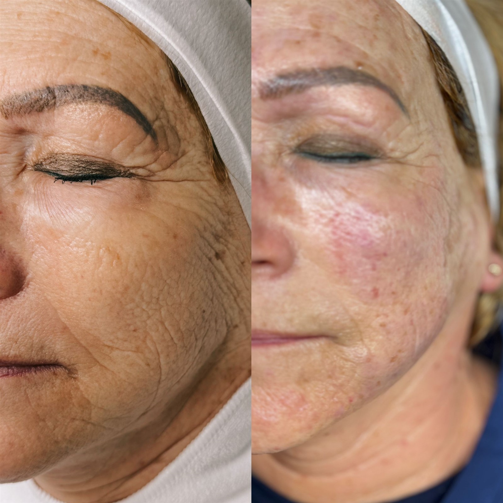 right after HIFU by Wasan right after HIFU by Wasan