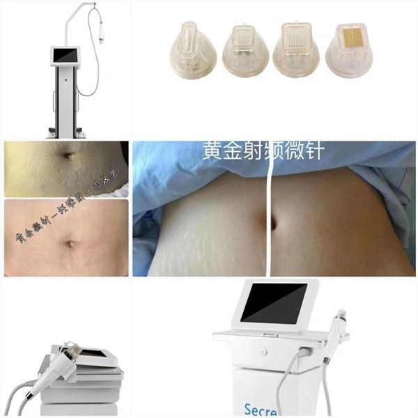 RF After Birth Therapy