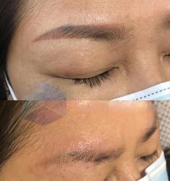 before after eyebrow removal2 before after eyebrow removal2
