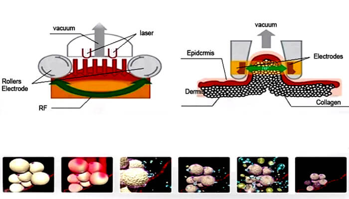cellushape treatment principle