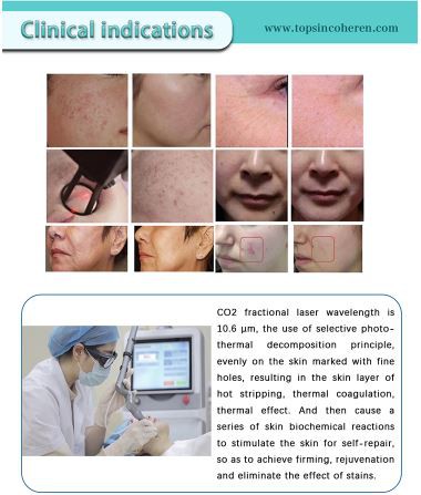 Co2 Vaginal Beauty Equipment