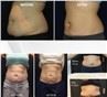 /uploads/202234052/small/cryolipolysis-fat-freezing-machine-weightlose55448263231.jpg