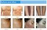 /uploads/202134052/small/fda-approve-ipl-hair-removal21107363036.jpg