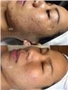 /uploads/202234052/small/microneedling-rf-skin-rejuvenation-machine24259200068.jpg