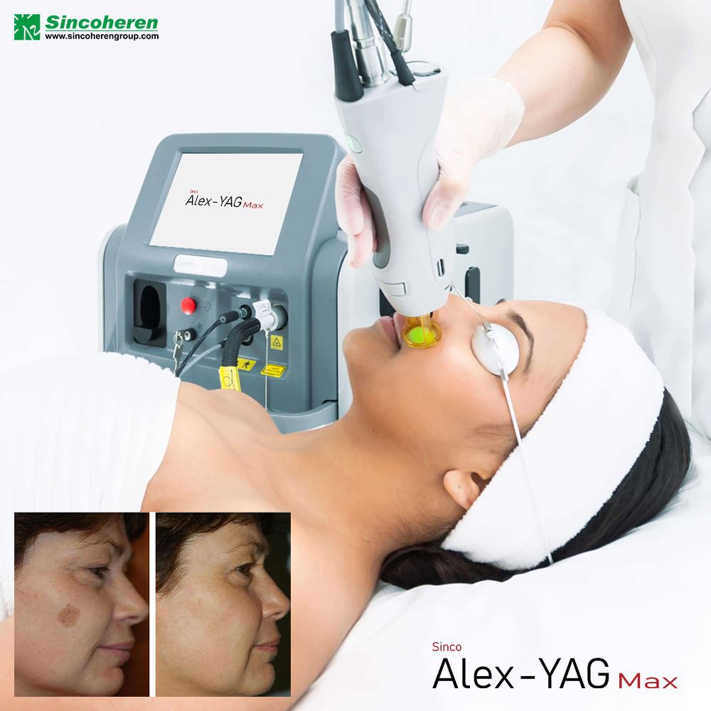 Fractional Laser To Remove Acne Pits, You Need To Understand These