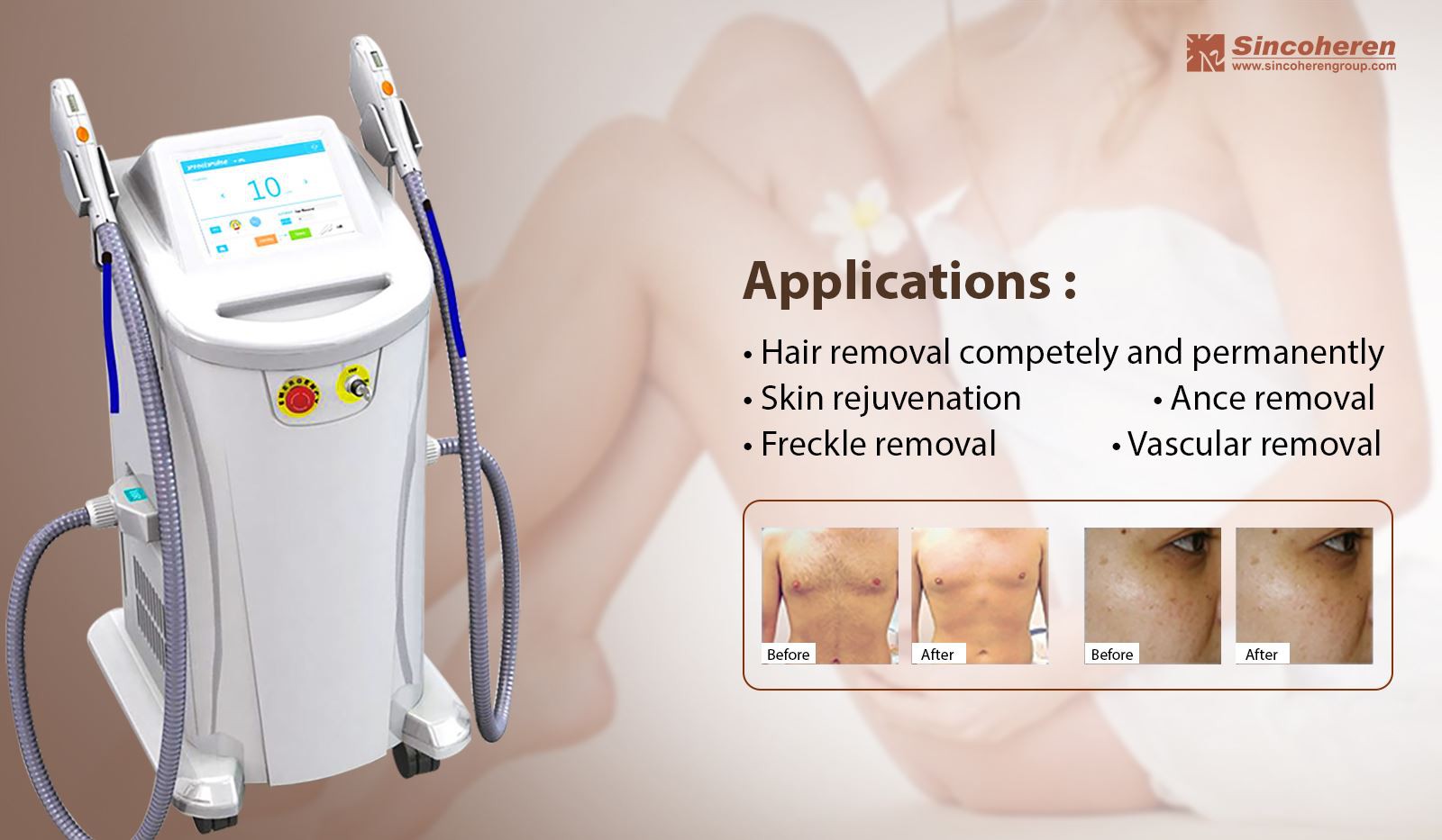 All You Must Know About IPL Hair Removal Machine