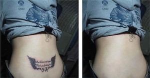 Portable ND YAg Tattoo Removal Best Machine