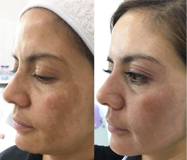 CE approved Q-Switched Laser Tattoo Removal hollywood facial and skin rejuvenataion Machine with local training and warranty in Europe