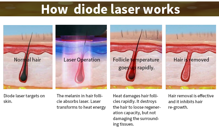 Soprano Alma xl 808nm painless laser diode laser hair removal user manual