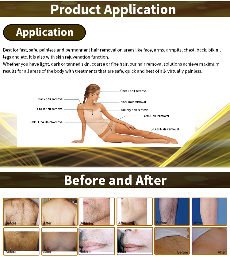Soprano Alma xl 808nm painless laser diode laser hair removal user manual