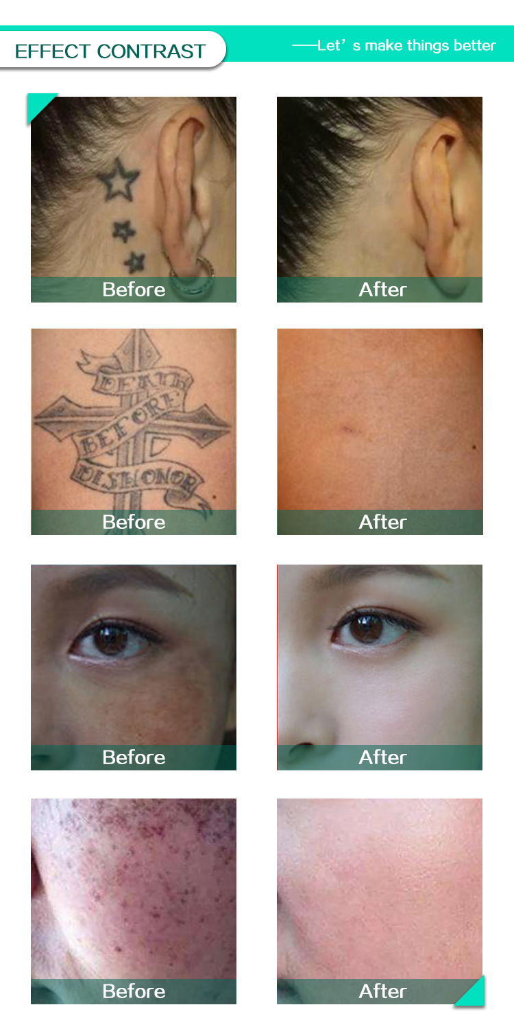 Q Switch ND YAG Tattoo Removal Machine