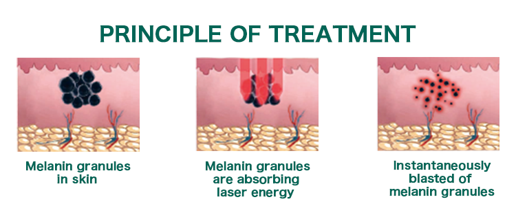 Q Switch ND YAG Tattoo Removal Machine