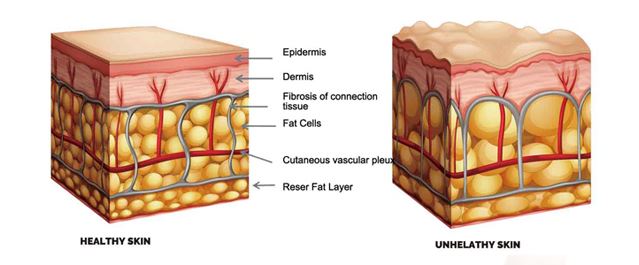 4D HIFU lift the skin