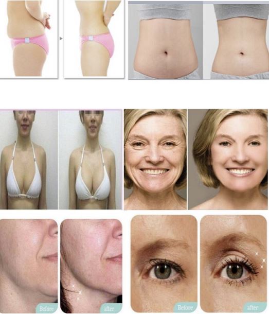 4D HIFU lift the skin