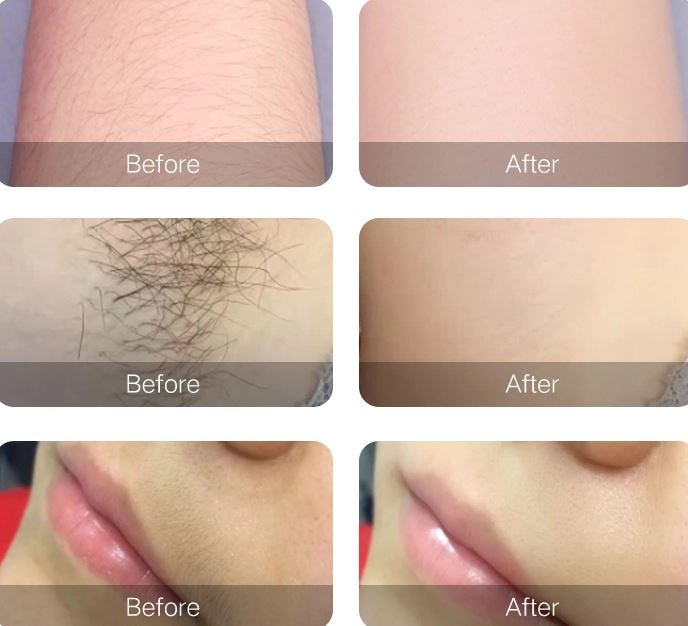 2021 popular diode laser remove hair machine