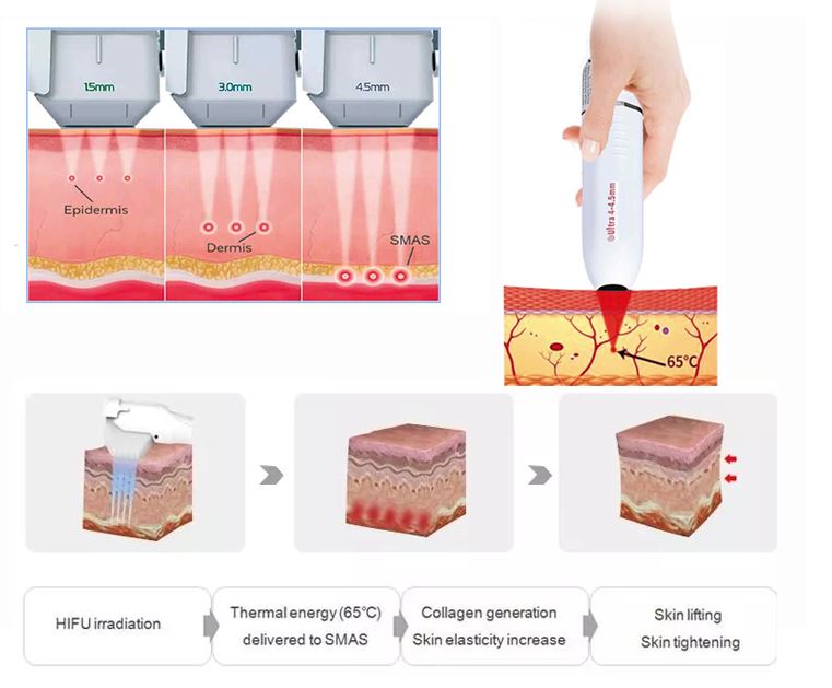 HIFU skin and vagina tightening HIFU skin and vagina tightening