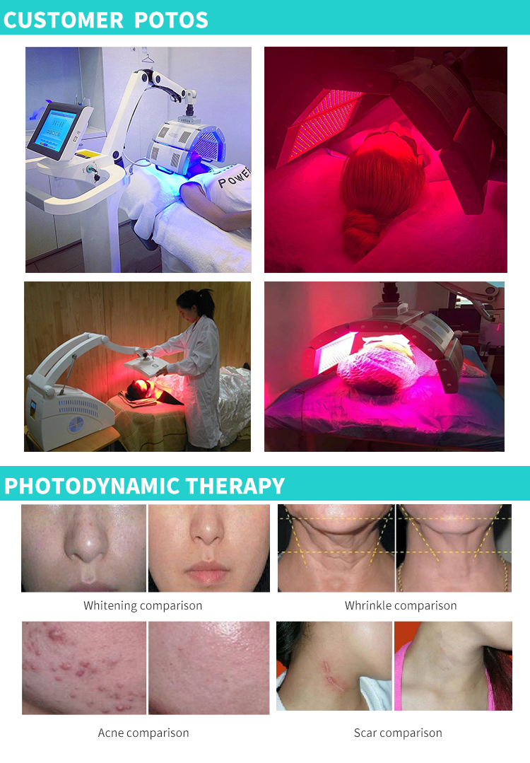 LED Whitening and removing acne LED Whitening and removing acne