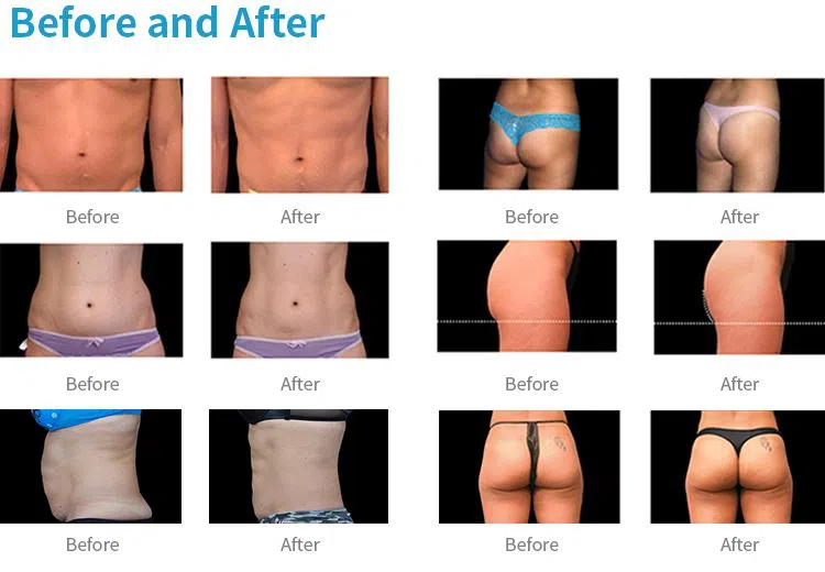 2021 white high frequency fat reduction machine sewing machine for elastic attachment