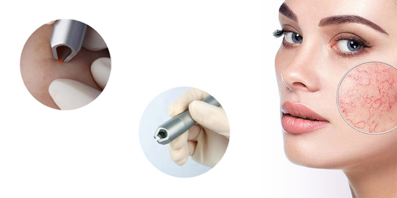 980 diode laser machine 980 diode laser machine