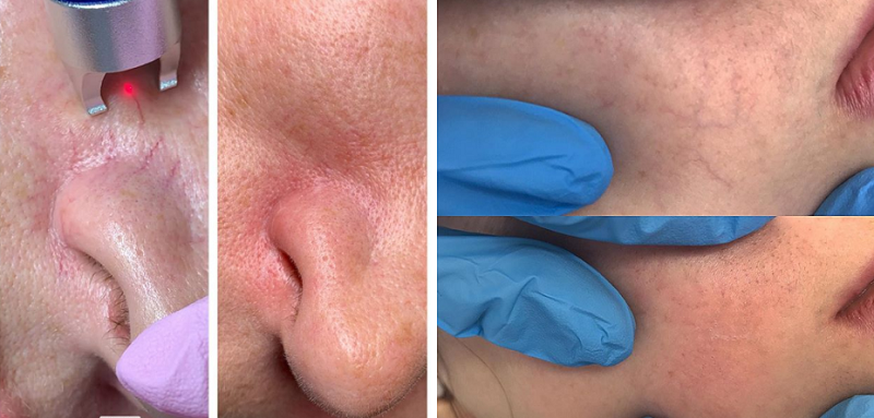 980 diode laser machine