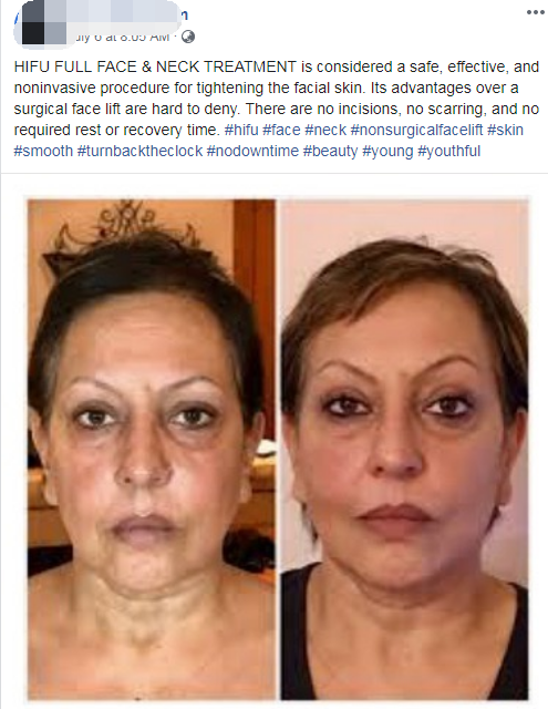 Australia HIFU 2 Australia HIFU 2