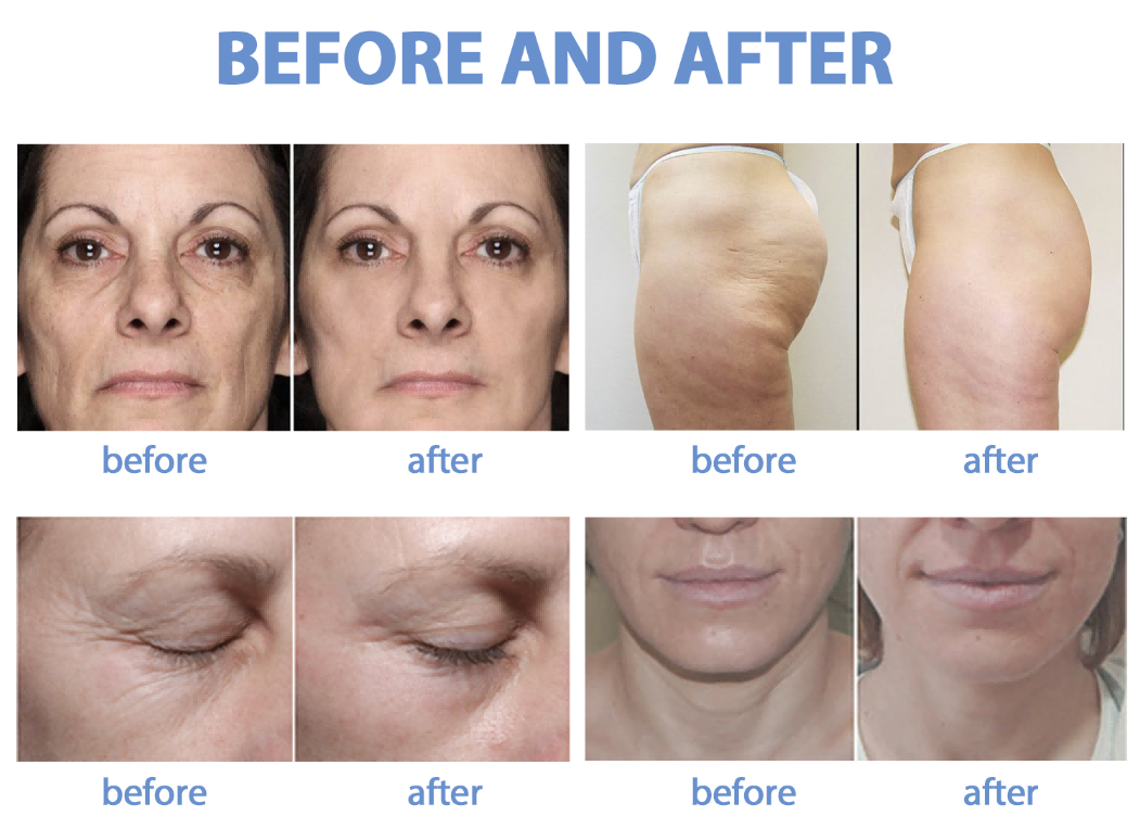 cellushape cavitation rf face and body machine before and after(1) cellushape cavitation rf face and body machine before and after(1)