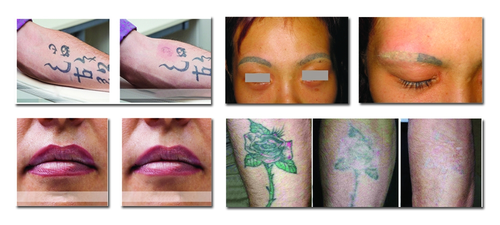 Before and After(1) Before and After(1)