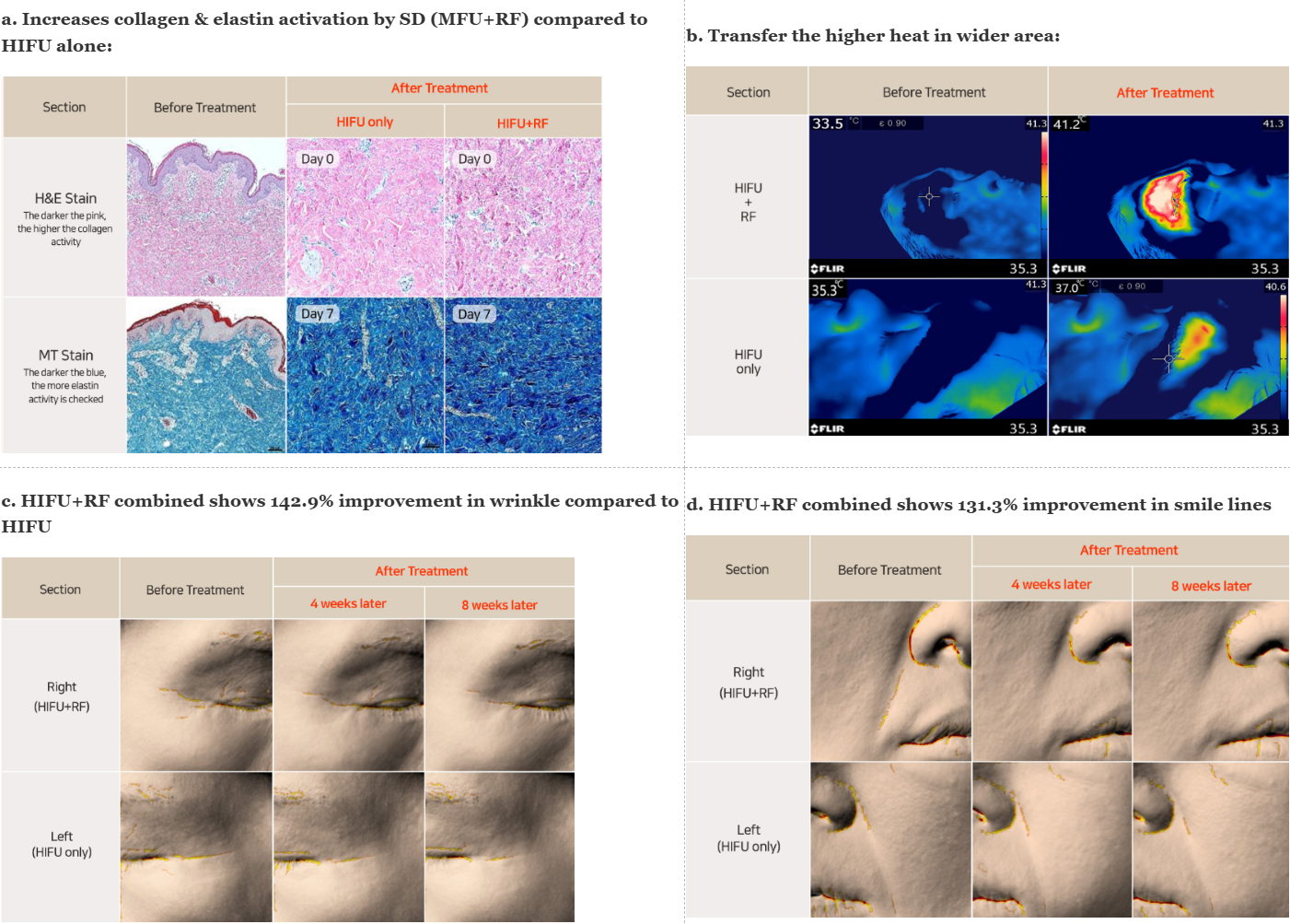 HIFU results HIFU results