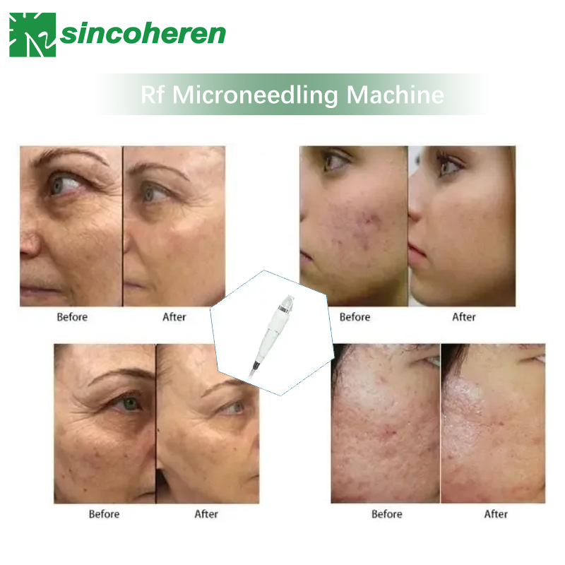 Portable RF Microneedle Fractional Machine