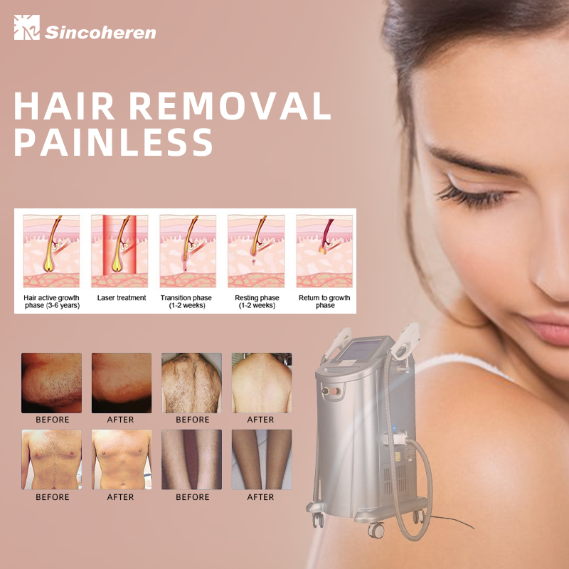 SHR IPL Machine Hair Removal & Skin Rejuvenation Equipment-Preci Pulse Machine